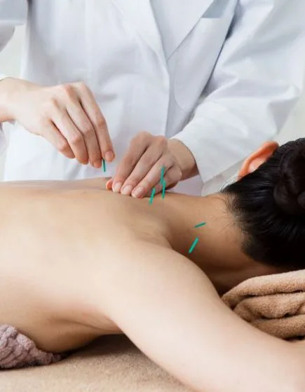 Acupuncture treatment on a patient’s upper back